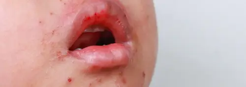 ХӨСҮТ: Урин дулааны улиралд гар, хөл, амны өвчнөөс сэргийлье